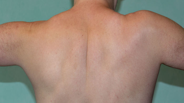 The story of how I became crooked, cross-eyed, and how a shoulder injury helped me with this - My, Crooked, Humpback, Losers, Injury, Scoliosis, Pain, Disease, Mat, Longpost