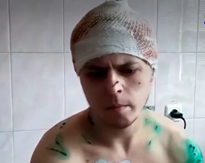 У Владимира из Хабаровска бродячие собаки сняли скальп.Фото: Кадр видео.