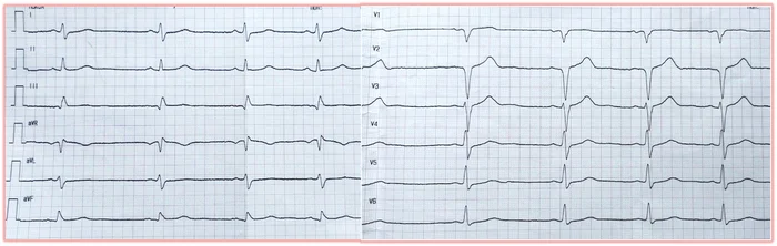 Heart attack at 21? Yes! - My, The medicine, Treatment, Health, Heart attack, Operation, Heart, No rating, Video, Soundless, Longpost