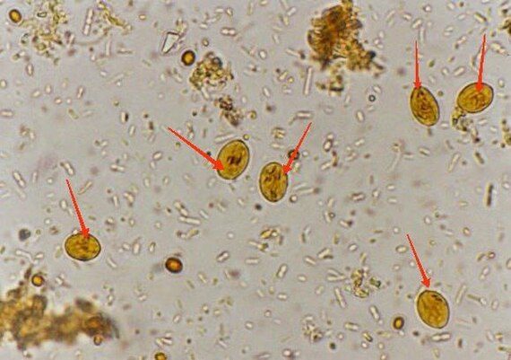 Giardiasis - My, Treatment, The medicine, Doctors, Giardia, Protozoa, Parasites, Longpost