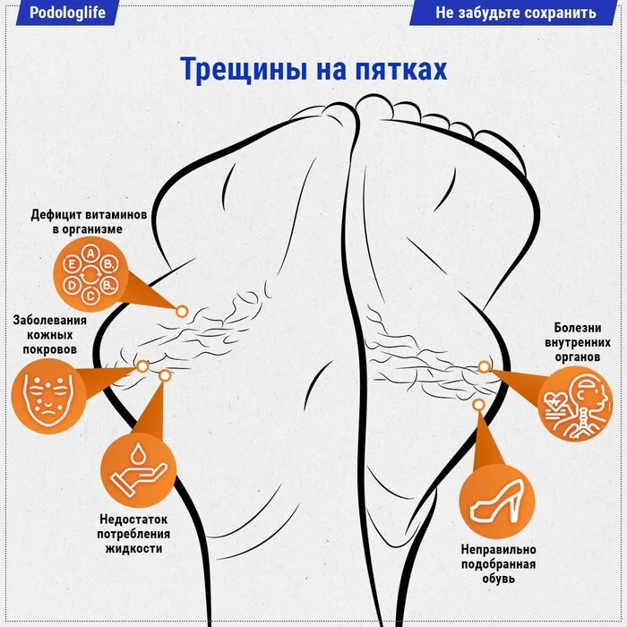 Cracks - My, Podology, Pedicure, Health, Crack, Feet