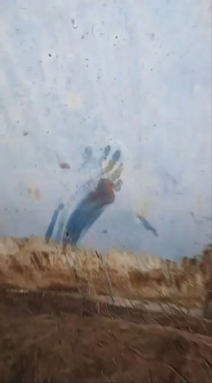 12-летняя девочка, на которую напала стая собак в поселке Чульман 7 октября, находится на грани жизни и смерти