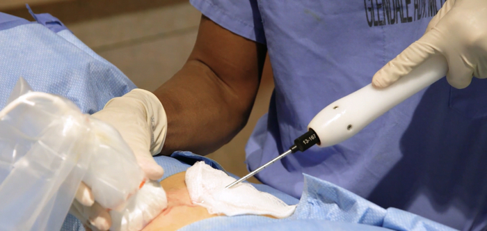 IceCure    ,    ,    (: )