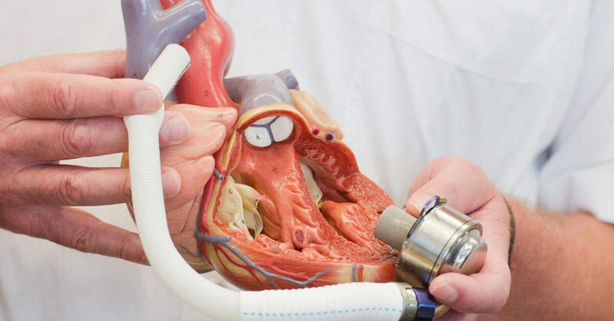 Искусственное сердце abiocor (2001). Создание искусственного сердца. Искусственное сердце abiocor. 3. Искусственное сердце протез.