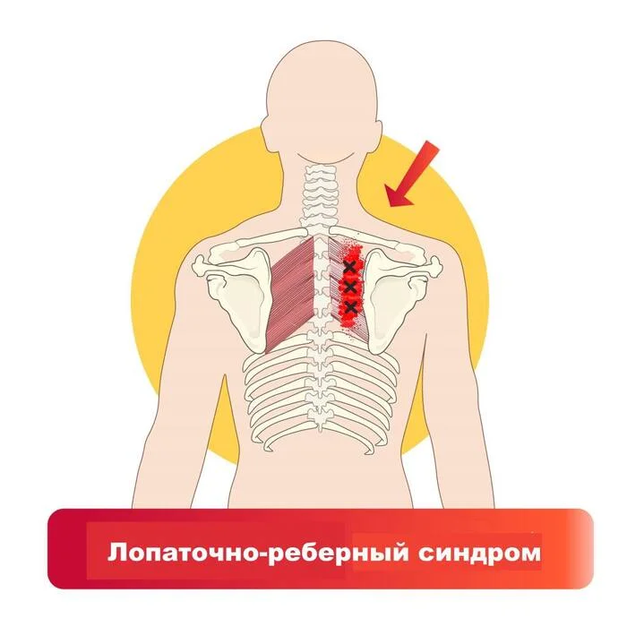 Pain under the shoulder blade. Causes and solution to the problem! - My, Massage, Notes of a massage therapist, Masseur