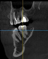 2 cysts of adjacent teeth at the same time - My, Cyst, Teeth, Disease, Disease history, Dentistry, Operation, The medicine, Dentist, Picture with text, Need advice, Question, Doctors, ENT-Doctors, Pain, Paid medicine, Ask Peekaboo, Toothache, Longpost