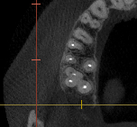 2 cysts of adjacent teeth at the same time - My, Cyst, Teeth, Disease, Disease history, Dentistry, Operation, The medicine, Dentist, Picture with text, Need advice, Question, Doctors, ENT-Doctors, Pain, Paid medicine, Ask Peekaboo, Toothache, Longpost