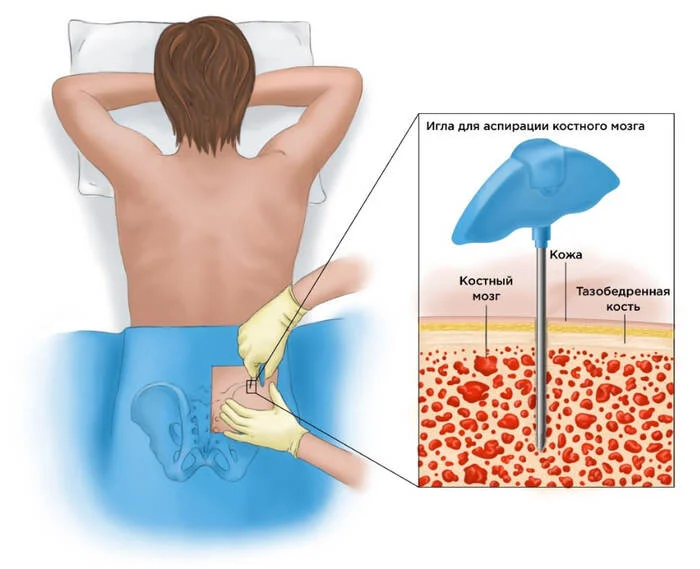 Bone marrow puncture - Health, Treatment, Disease, Cancer and oncology, The medicine, Puncture, Marrow