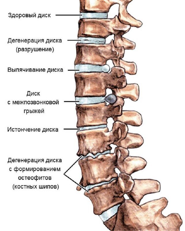 It's because of osteochondrosis that I have pain. - My, Crossposting, Pikabu publish bot, Osteochondrosis, Telegram (link), Longpost