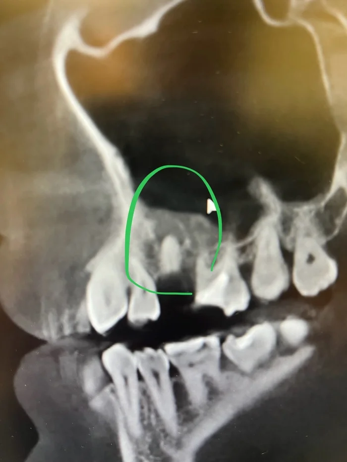 Как выглядит воспаление на верхушке корня зуба? - Моё, Стоматология, Врачи, Медицина, Здоровье, Ответ, Киста, Зубы, Лечение, Стоматолог, Хирургия, Кровь, Удаление зубов, Воспаление, Длиннопост