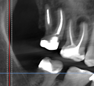 2 cysts of adjacent teeth at the same time - My, Cyst, Teeth, Disease, Disease history, Dentistry, Operation, The medicine, Dentist, Picture with text, Need advice, Question, Doctors, ENT-Doctors, Pain, Paid medicine, Ask Peekaboo, Toothache, Longpost