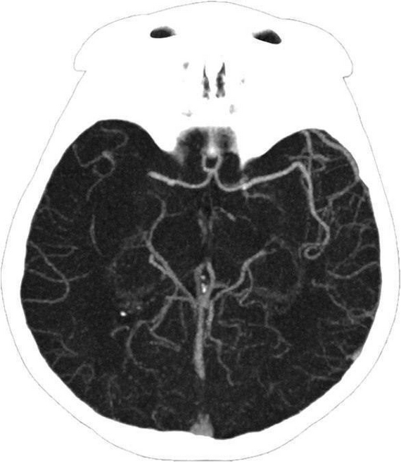 Moscow surgeons save young woman from stroke by removing giant 25cm blood clot - The medicine, Treatment, Thrombus, Doctors, Operation, Video, Video VK, Longpost