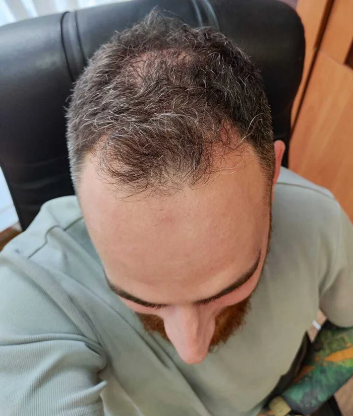 Hair, or There and Back Again - My, Hair Transplant, Operation, Longpost