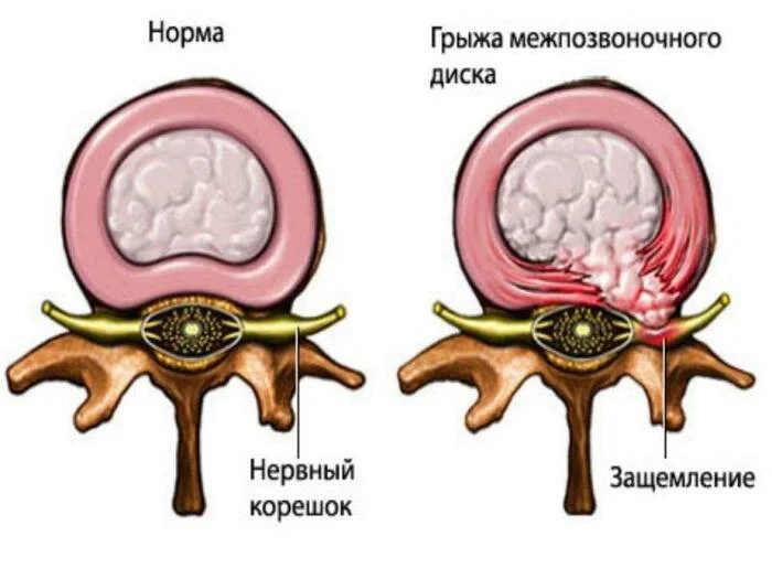 Как лечится грыжа межпозвонкового диска? - Моё, Здоровье, Медицина, Лекарства, Лечение, Боль в пояснице