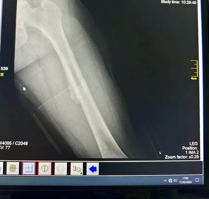 Broken leg - My, Broken leg, Help, Question, Ask Peekaboo, Longpost