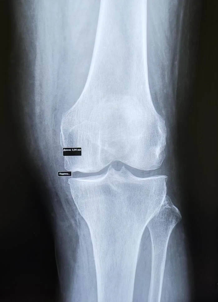 Gonarthrosis 2nd stage - My, The medicine, Army, Knee, Joints, Gonarthrosis, X-ray, Radiology, Orthopedics, Conscription, Conscripts, Longpost