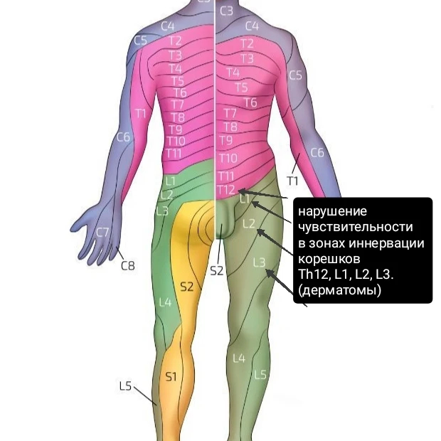 Follow your doctor's recommendations! - My, Recommendations, The medicine, Everything is running, Stroke, Atherosclerosis, Inflammation, Vertebrae, Nerves, Diagnosis, Neurology, Longpost