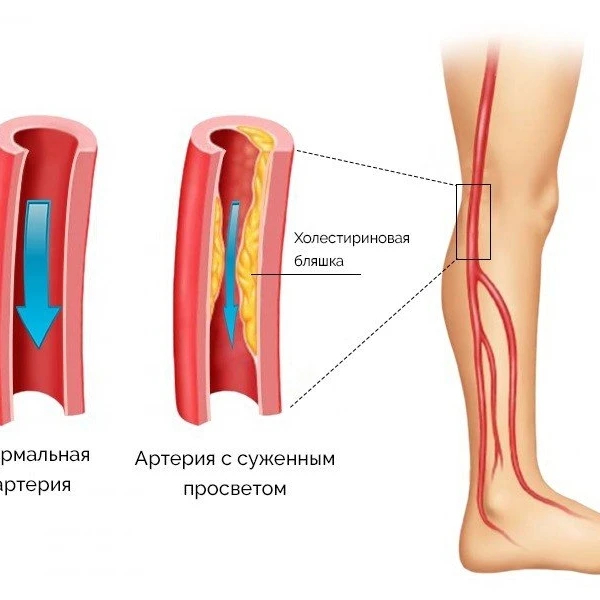 Follow your doctor's recommendations! - My, Recommendations, The medicine, Everything is running, Stroke, Atherosclerosis, Inflammation, Vertebrae, Nerves, Diagnosis, Neurology, Longpost