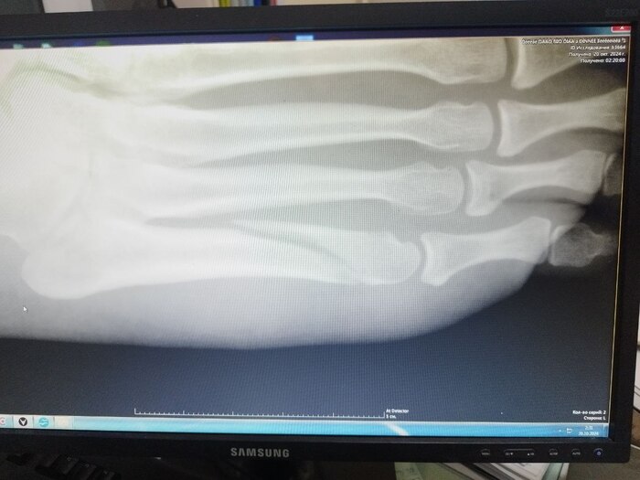 Да, это самый распространенный перелом, но за несколько лет скакания по горам в дёшевых треках ни разу не жаловалась на проблемы со стопами.