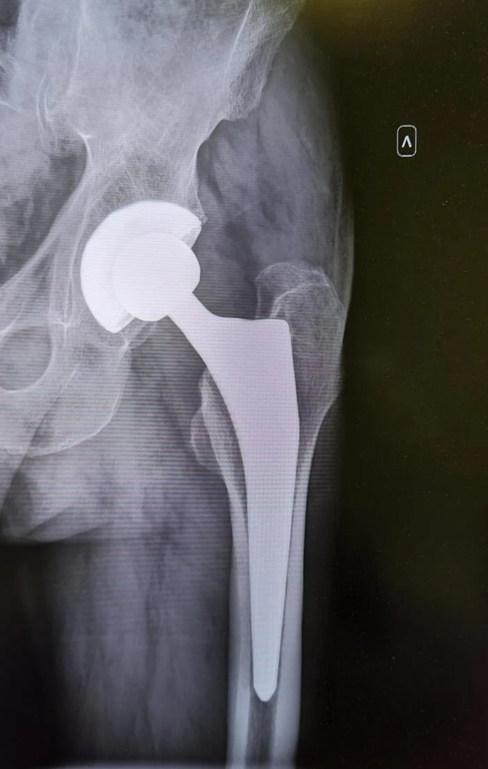 Hip replacement - My, The medicine, Army, Prosthetics, Prosthesis, Joints, Traumatology, X-ray, Radiology, Conscripts, The appeal, Conscription