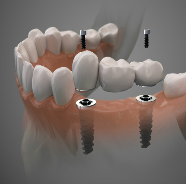 Saga of Dentistry. Chapter 99. Why can't a tooth and an implant be connected with a bridge? - My, Dentistry, The medicine, Doctors, Implants, Health, Prosthetics, Teeth, Crowns, Polyclinic, Work, Mechanics, Treatment, Problem, Dentist, Longpost