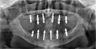 No Teeth at 37. All in 6 - My, Disease history, Disease, Doctors, Teeth, Implants, Implantation, Girls, Dentistry, Surgeon, Longpost