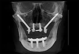 No Teeth at 37. All in 6 - My, Disease history, Disease, Doctors, Teeth, Implants, Implantation, Girls, Dentistry, Surgeon, Longpost