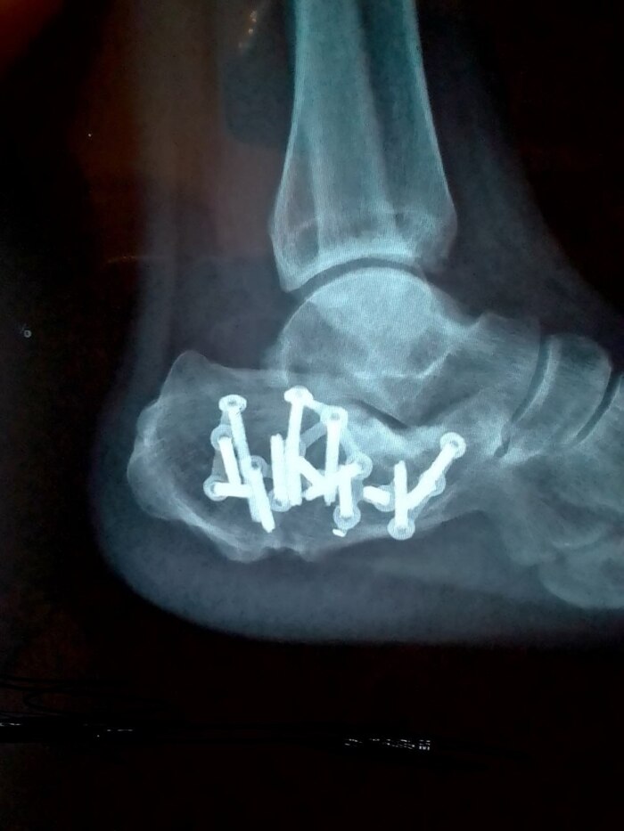 Первая операция.