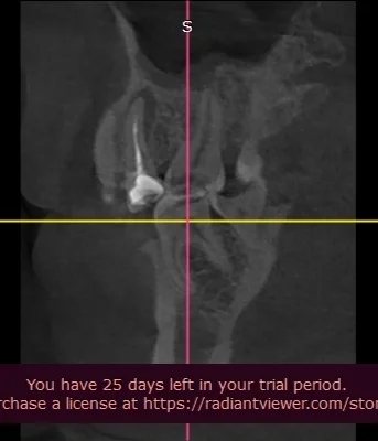 Periodontitis. Is it possible to save a tooth? - My, Dentistry, Dentist, Periodontitis, Help, Teeth, Cyst, Question