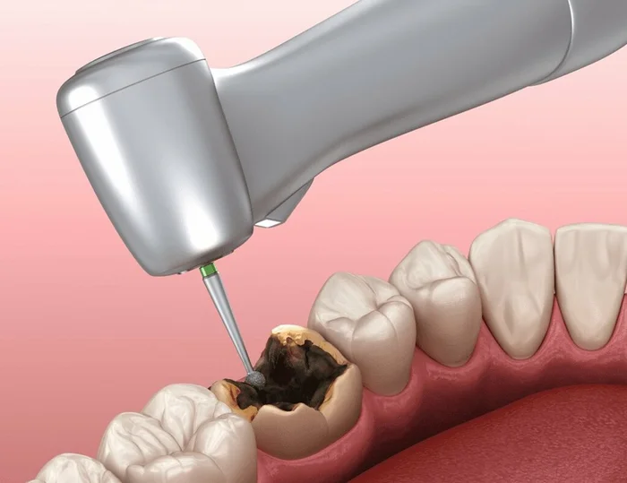 Saga of Dentistry. Chapter 101. How to restore a tooth if it is badly damaged? - My, Dentistry, Teeth, Dentist, Health, Recovery, Operation, Work, Crown, Doctors, Problem, Question, Answer, Longpost