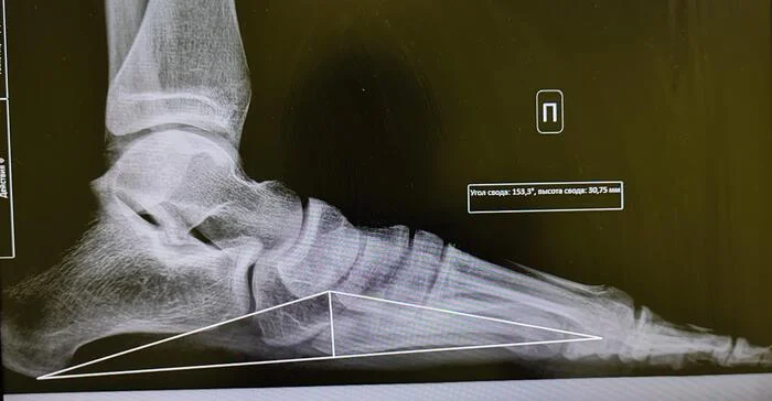 Longitudinal flatfoot 3 st - My, Army, The medicine, Flat feet, X-ray, Radiology, Orthopedics, Conscripts, Conscription, Feet