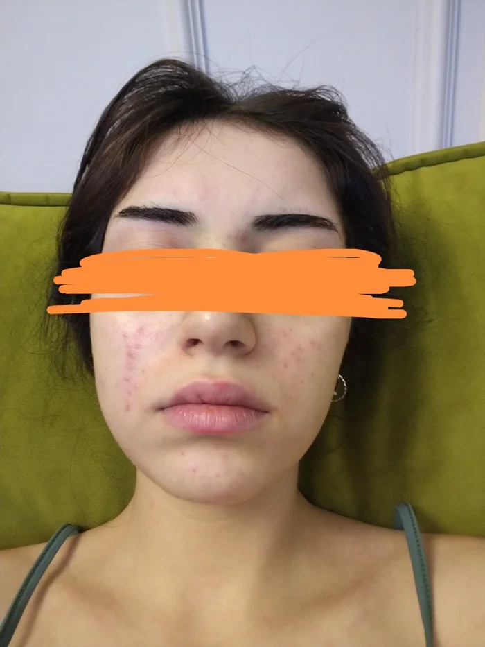 Help - Acne, Help, Need advice