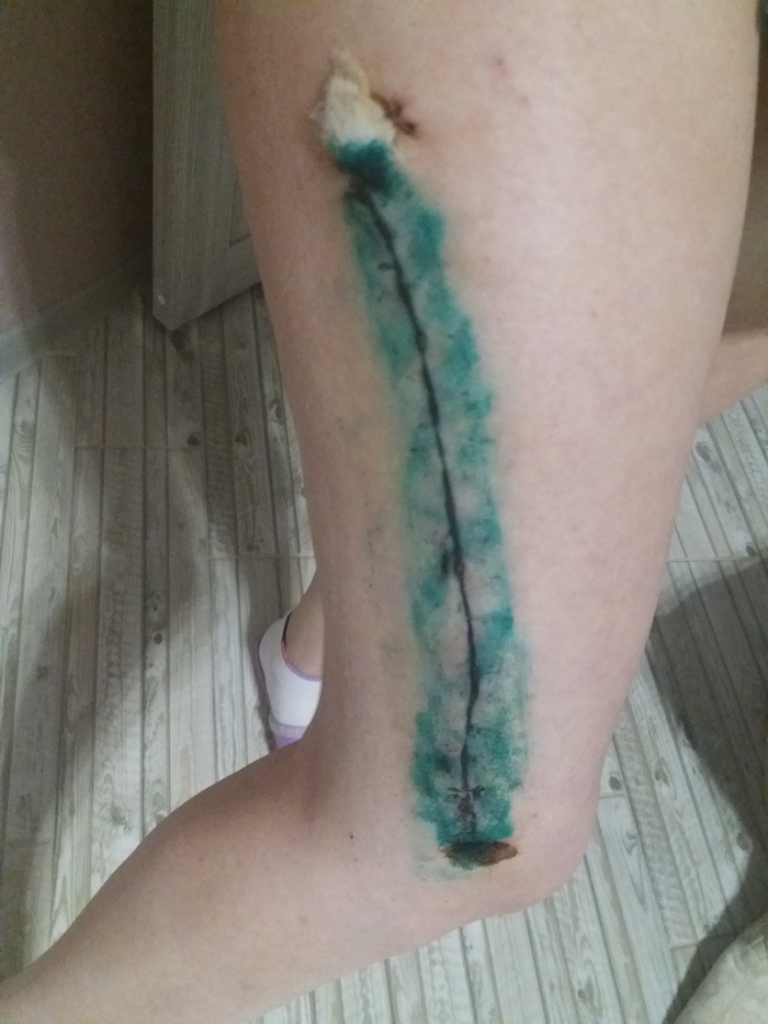 Ответ на пост «Реабилитация. Тебе отрежут руку, но всё закончится хорошо» Травма, Реабилитация, Нейрохирургия, Истории из жизни, История болезни, Травматология, Рассказ, Ответ на пост, Длиннопост