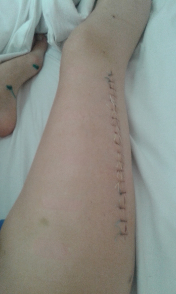 Ответ на пост «Реабилитация. Тебе отрежут руку, но всё закончится хорошо» Травма, Реабилитация, Нейрохирургия, Истории из жизни, История болезни, Травматология, Рассказ, Ответ на пост, Длиннопост