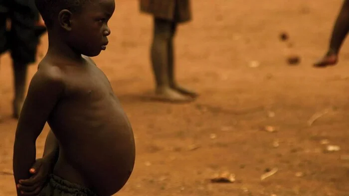 Why are African children thin but have a big belly? - Health, The medicine, Africa, Disease, Proper nutrition, Liver, Children