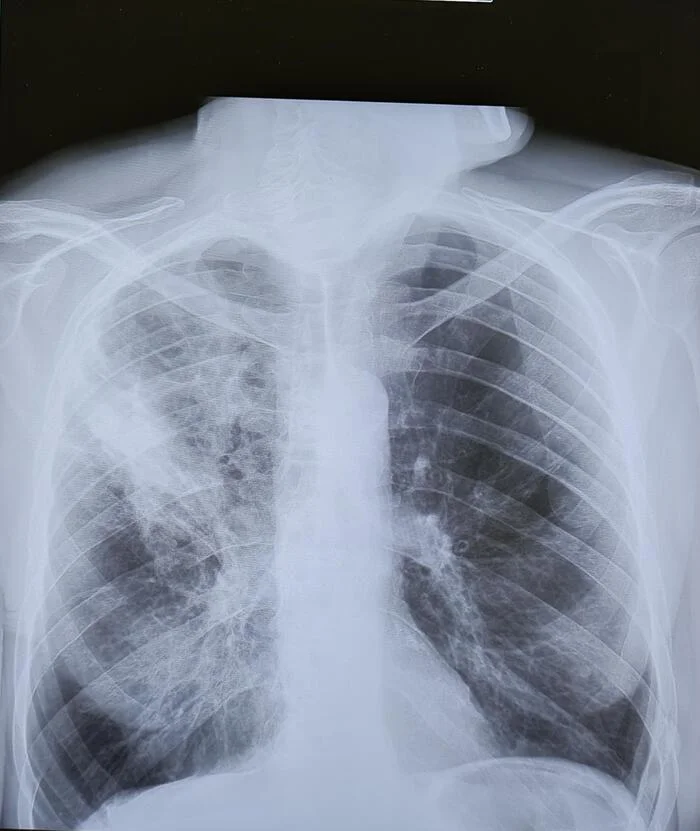 Community-acquired pneumonia - X-ray - My, The medicine, Army, Health, Treatment, Military enlistment office, Summons to the military enlistment office, Pneumonia, Lungs, X-ray, Radiology, Conscripts, Longpost