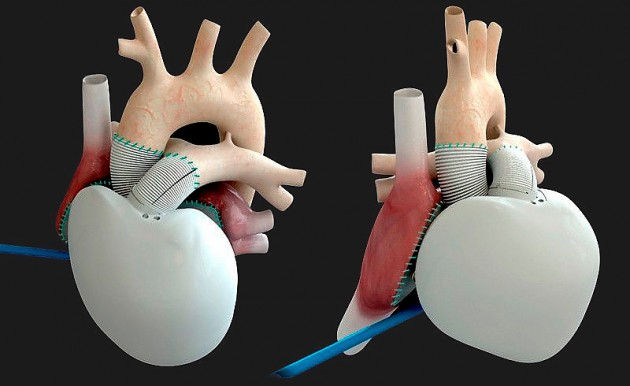 Artificial heart transplant - My, The science, Scientists, Research, Heart, Artificial, Artificial heart, Technologies, Heart transplant, Transfer, Operation, Inventions, A life, Longpost