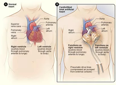 Artificial heart transplant - My, The science, Scientists, Research, Heart, Artificial, Artificial heart, Technologies, Heart transplant, Transfer, Operation, Inventions, A life, Longpost