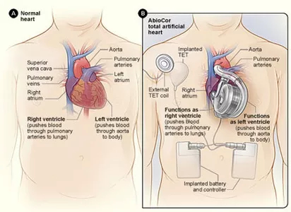 Artificial heart transplant - My, The science, Scientists, Research, Heart, Artificial, Artificial heart, Technologies, Heart transplant, Transfer, Operation, Inventions, A life, Longpost