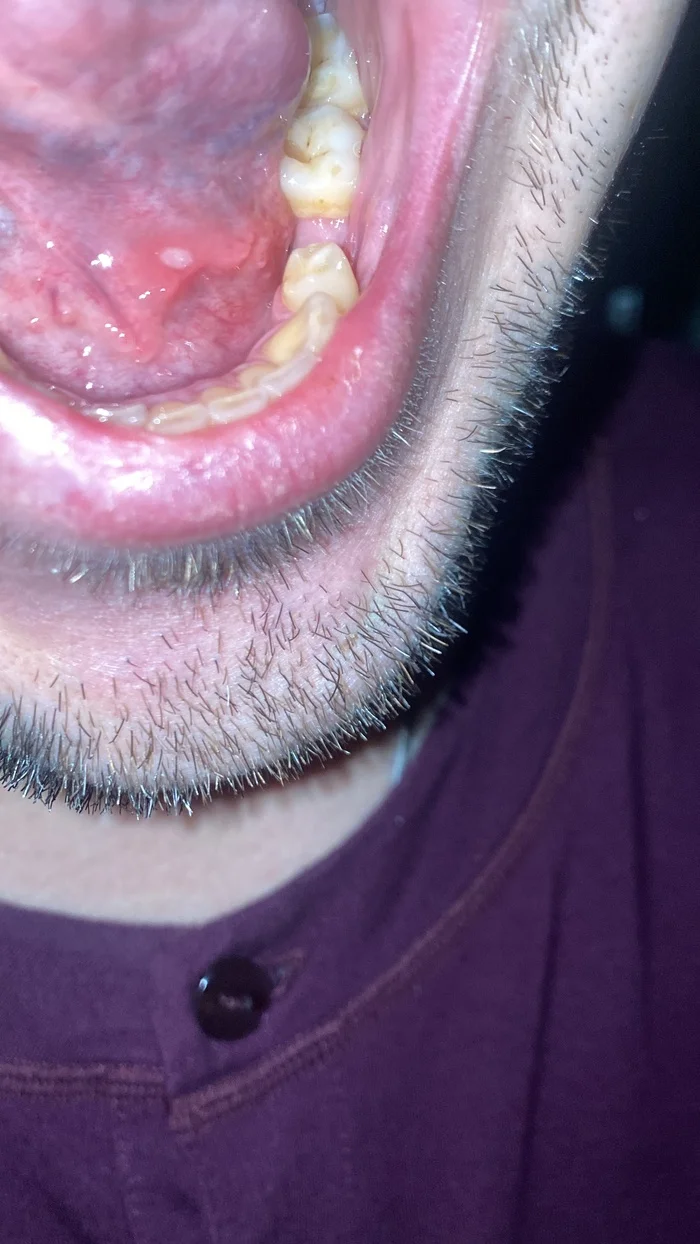 Sore under the tongue - what is it? - My, Question, Ask Peekaboo, Milota, Stomatitis