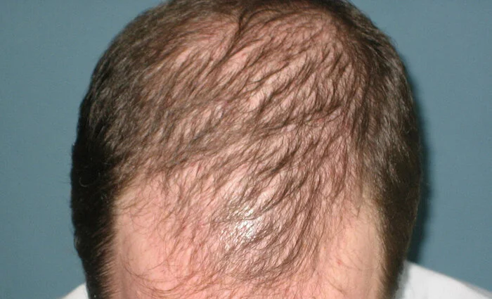 Hair transplant - My, Hair Transplant, Baldness, Alopecia