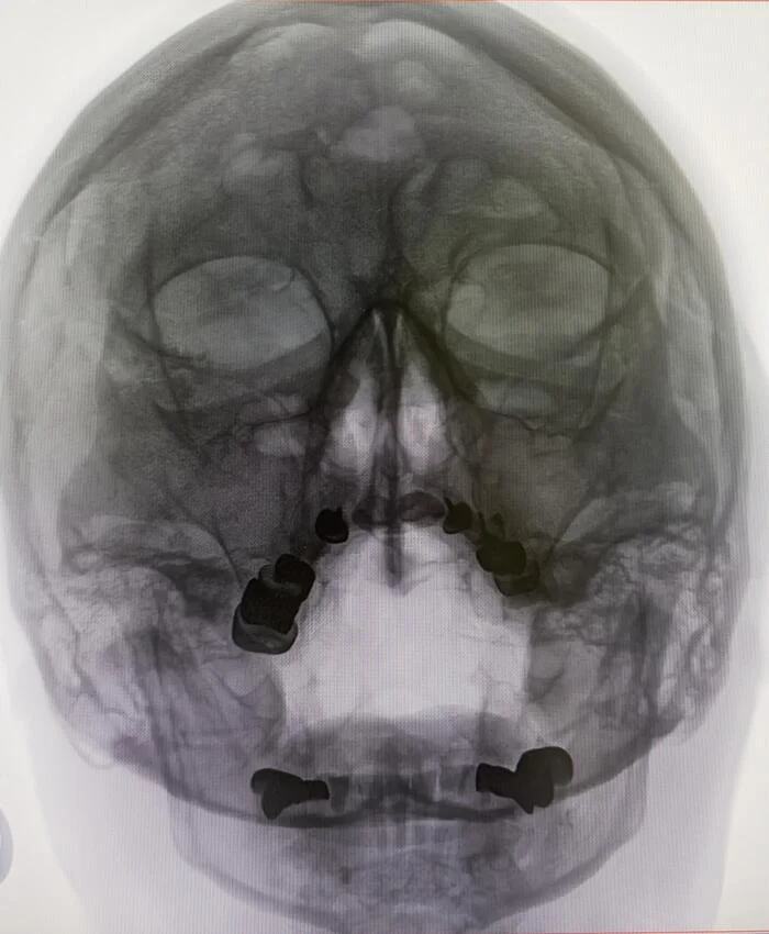 Pansinusitis - My, The medicine, Medications, Army, Treatment, Sinusitis, Sinusitis, ENT-Doctors, X-ray, Radiology, Sinuses, Military enlistment office, Conscripts, Longpost