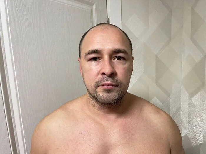 Reply to post I had a hair transplant and really regretted it... - Gratitude, Hair Transplant, Personal experience, Video, Vertical video, Longpost, It Was-It Was, Hair, Blood, The photo, Trypophobia, Baldness, Advertising, Reply to post