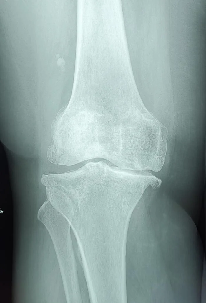 Chondromatosis of the knee joint - My, The medicine, Army, Military enlistment office, Knee, Joints, X-ray, Radiology, Arthroscopy, Operation, Treatment, Conscripts, Service, Traumatology, Longpost