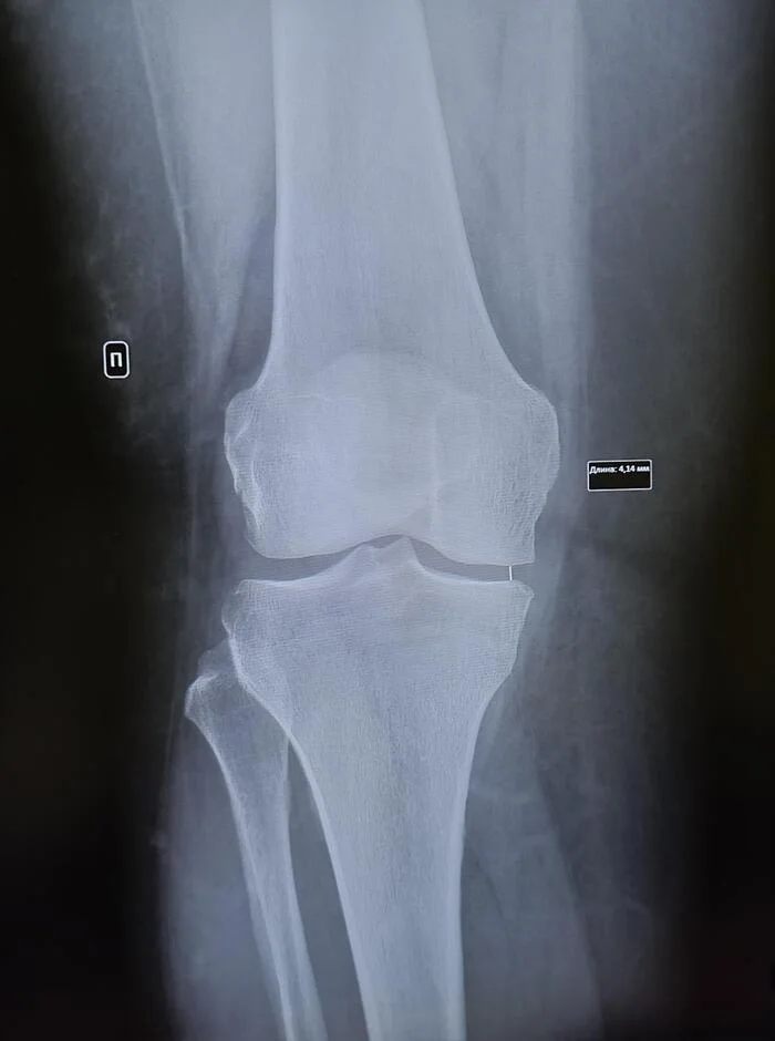 Rheumatoid arthritis of the knee joint - My, The medicine, Army, Rheumatoid arthritis, Rheumatology, X-ray, Radiology, Military enlistment office, Joints, Conscripts, Knee, Longpost