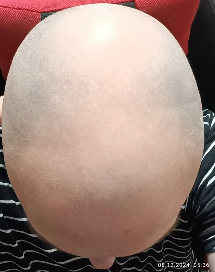 My Struggle with Baldness, Day ~200, Conclusion - My, Bald, Baldness, Alopecia, Health, Hormones, Medications, Treatment, Disease, Longpost, Diagnostics, Minoxidil, Finasteride, Mezoroller, Mat