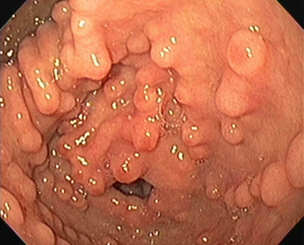 Eosinophilic gastroenteritis - Health, The medicine, Disease, Gastrointestinal tract