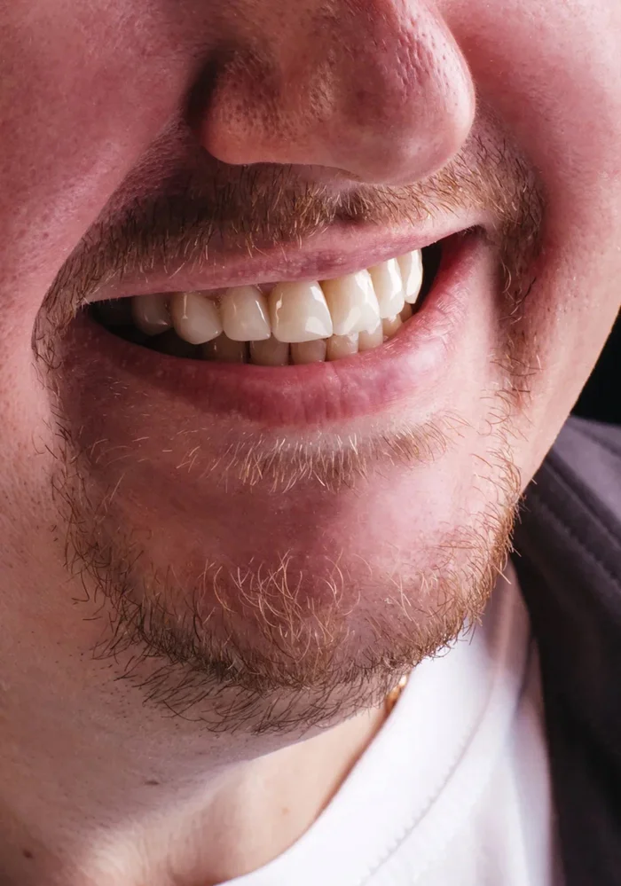 Should I install juveniles or veneers: how to choose a clinic and a doctor to install dental crowns? - My, Dentistry, Dentist, Veneers, Teeth, Smile, Innovations, Trend, Tomsk, Longpost
