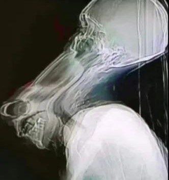 Sneezed during an x-ray - Memes, Humor, Black humor, X-ray, Scull, Telegram (link)