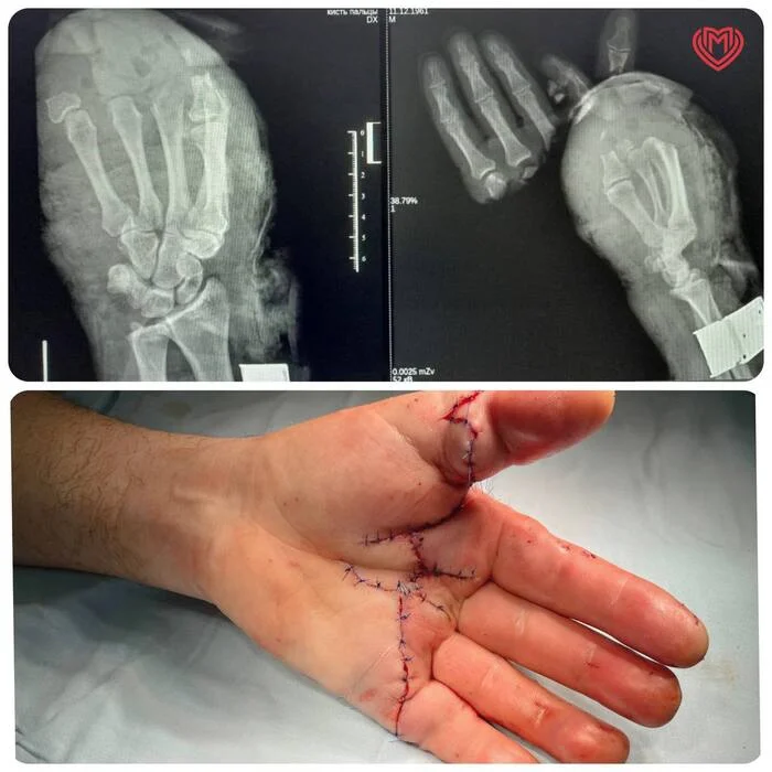 Microsurgeons reattached 5 fingers during one operation - The medicine, Operation, Doctors, news, Injury, Surgery, Moscow, Longpost, Repeat, Amputation, sewn on